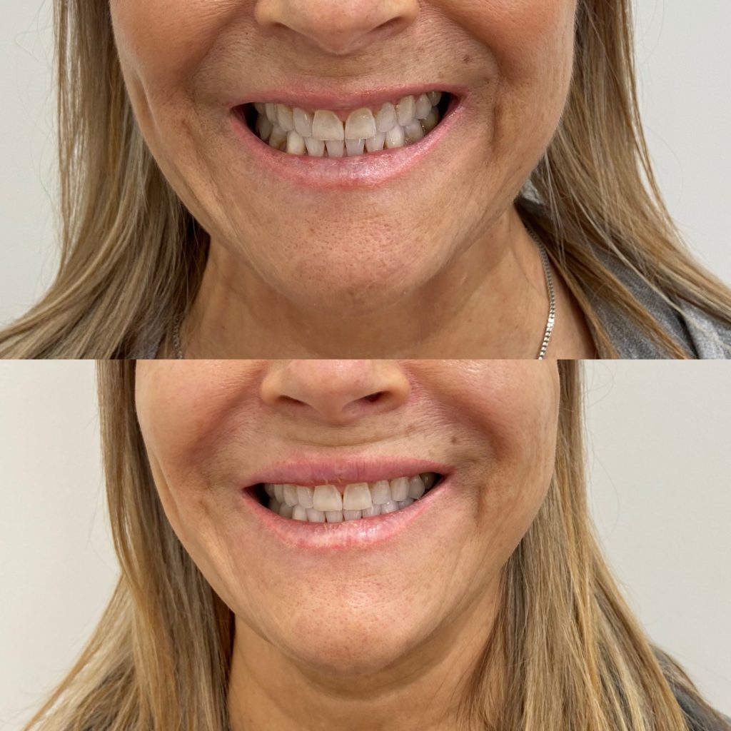 Before and After Lip lines flip Treatment | Beauty Boost Med Spa in Newport Beach, CA
