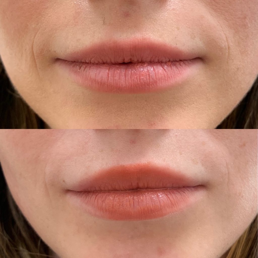 Before and After Lip lines flip Treatment | Beauty Boost Med Spa in Newport Beach, CA