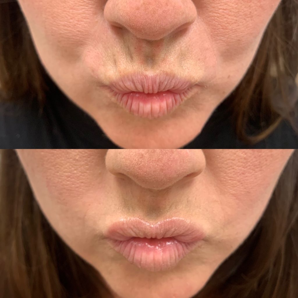 Before and After Lip lines flip Treatment | Beauty Boost Med Spa in Newport Beach, CA