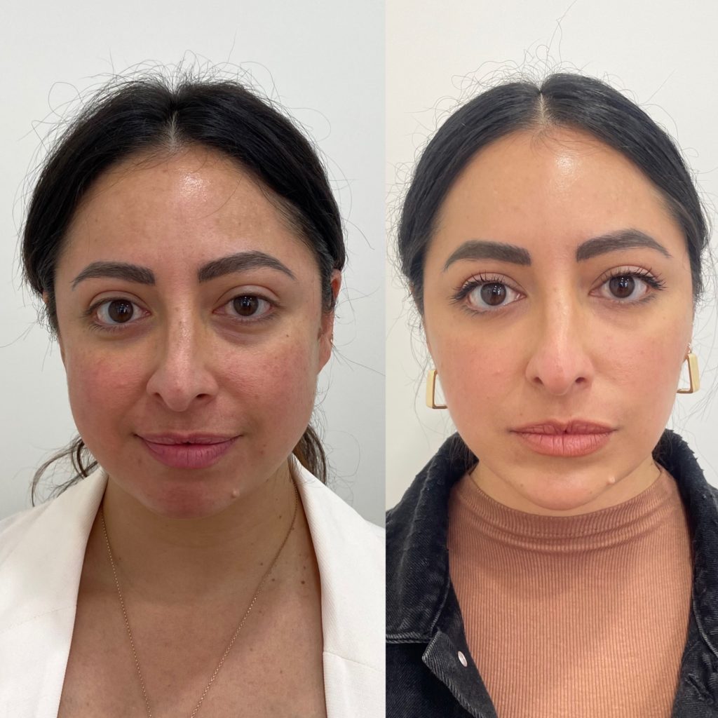 Before and After Botox Masseters Treatment | Beauty Boost Med Spa in Newport Beach, CA