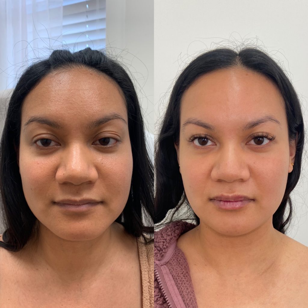 Before and After Botox Masseters Treatment | Beauty Boost Med Spa in Newport Beach, CA
