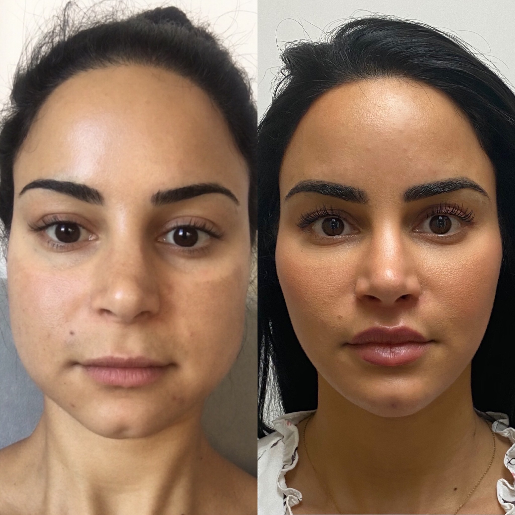 Before and After Botox Masseters Treatment | Beauty Boost Med Spa in Newport Beach, CA