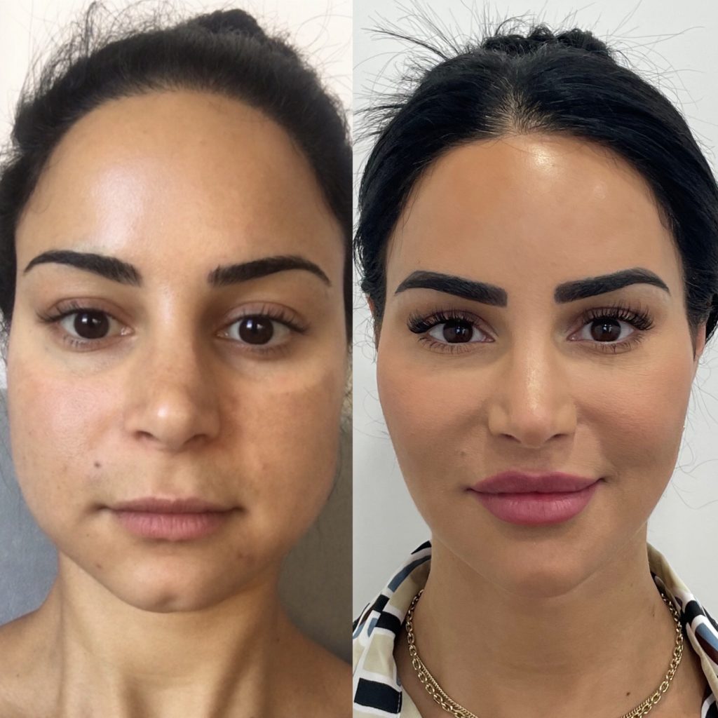 Before and After Botox Masseters Treatment | Beauty Boost Med Spa in Newport Beach, CA