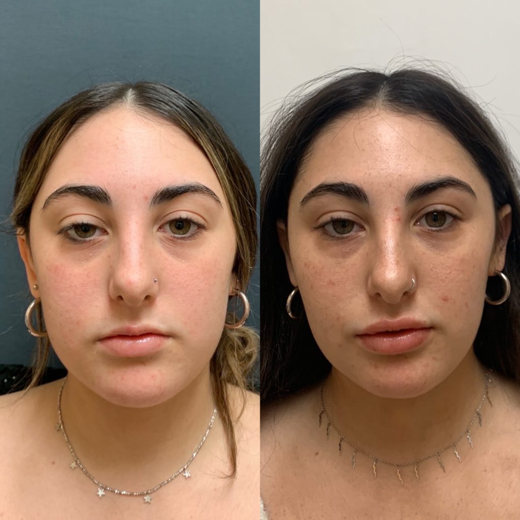 Before and After Botox Masseters Treatment | Beauty Boost Med Spa in Newport Beach, CA