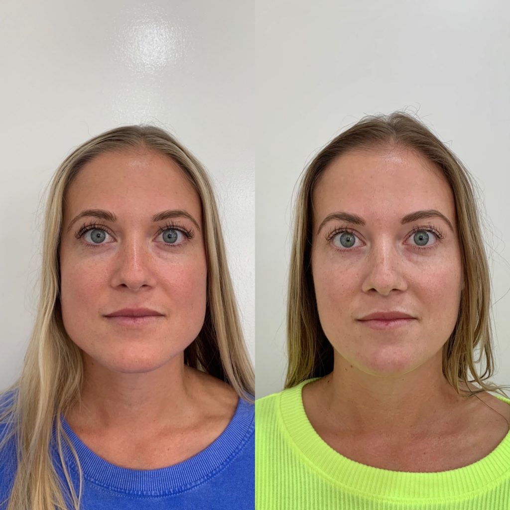 Before and After Botox Masseters Treatment | Beauty Boost Med Spa in Newport Beach, CA