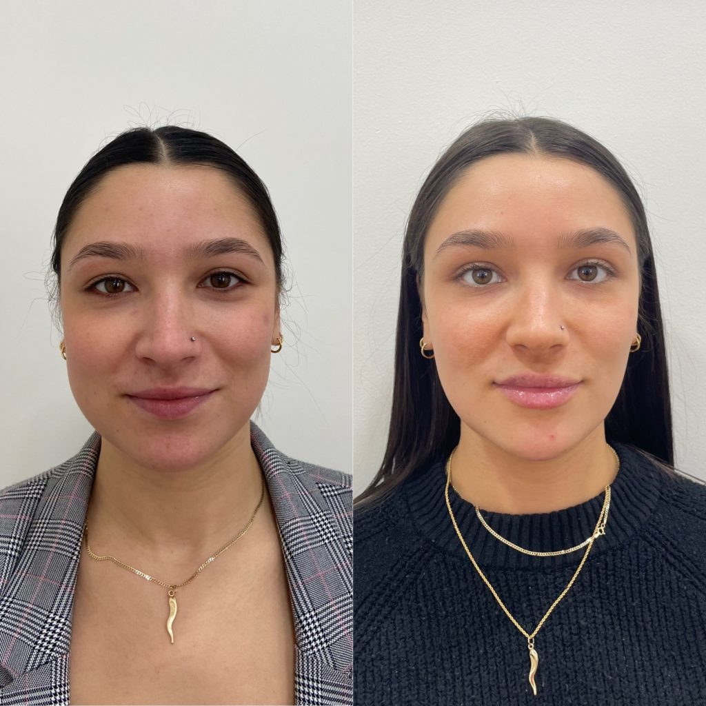 Before and After Botox Masseters Treatment | Beauty Boost Med Spa in Newport Beach, CA