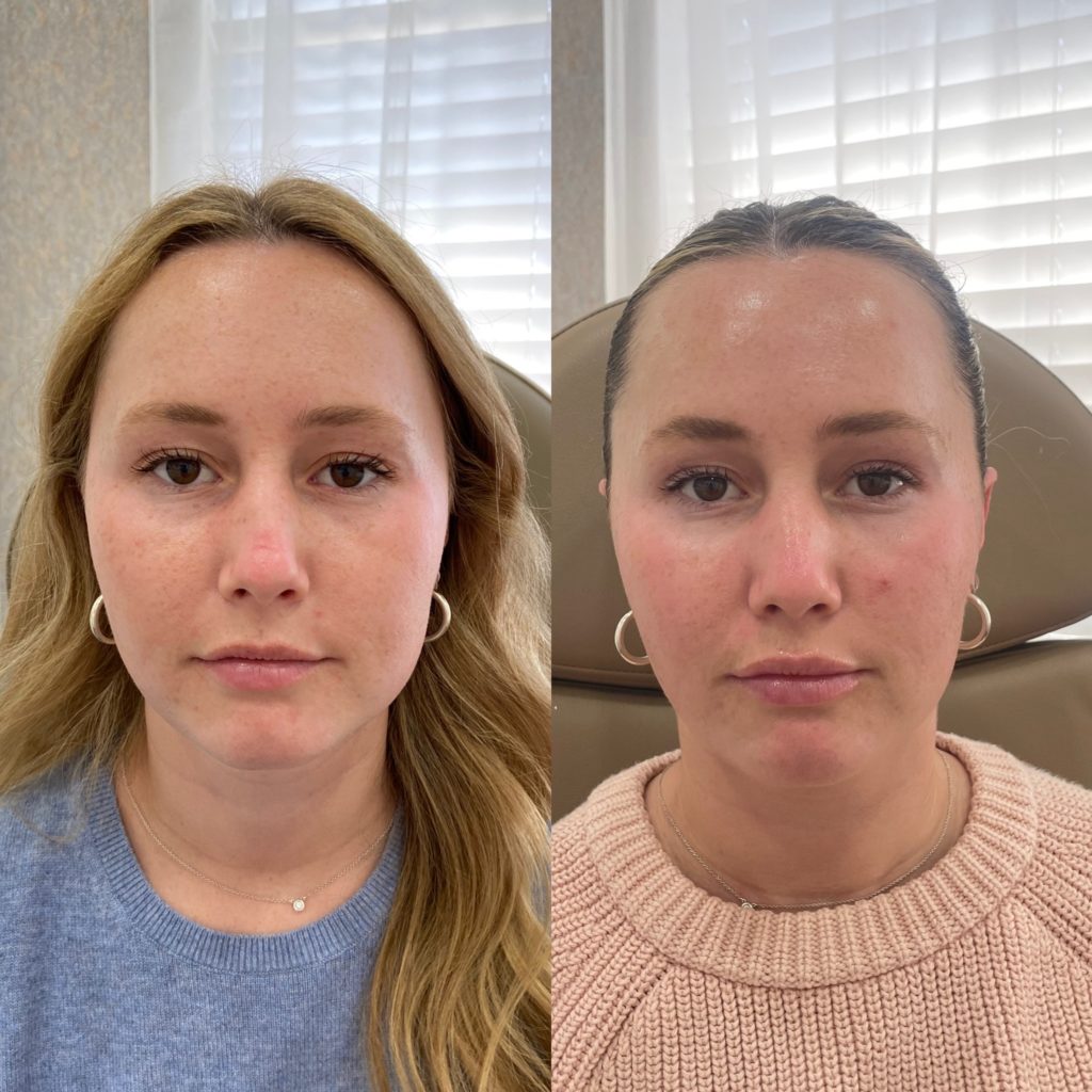 Before and After Botox Masseters Treatment | Beauty Boost Med Spa in Newport Beach, CA