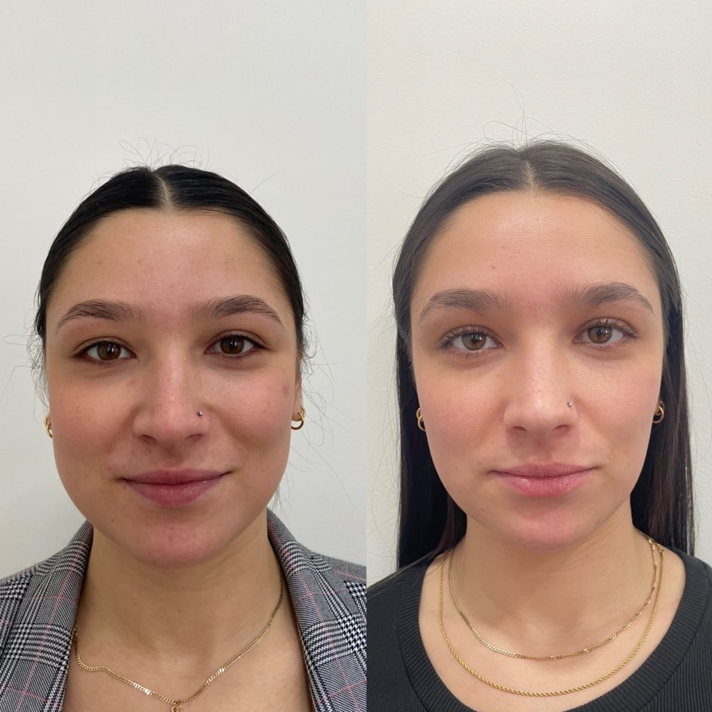 Before and After Botox Masseters Treatment | Beauty Boost Med Spa in Newport Beach, CA