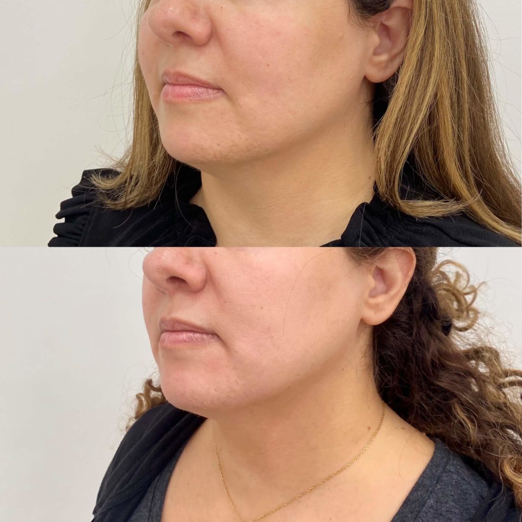 Before and After Microneedling PRP/PRF Treatment | Beauty Boost Med Spa in Newport Beach, CA