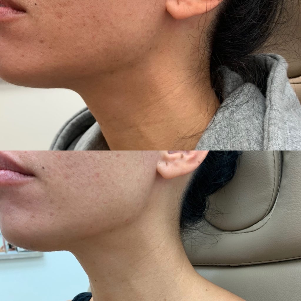 Before and After Treatment on Neck | Beauty Boost Med Spa in Newport Beach, CA