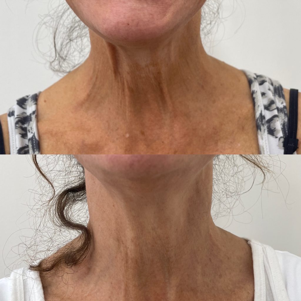 Before and After Treatment on Neck | Beauty Boost Med Spa in Newport Beach, CA