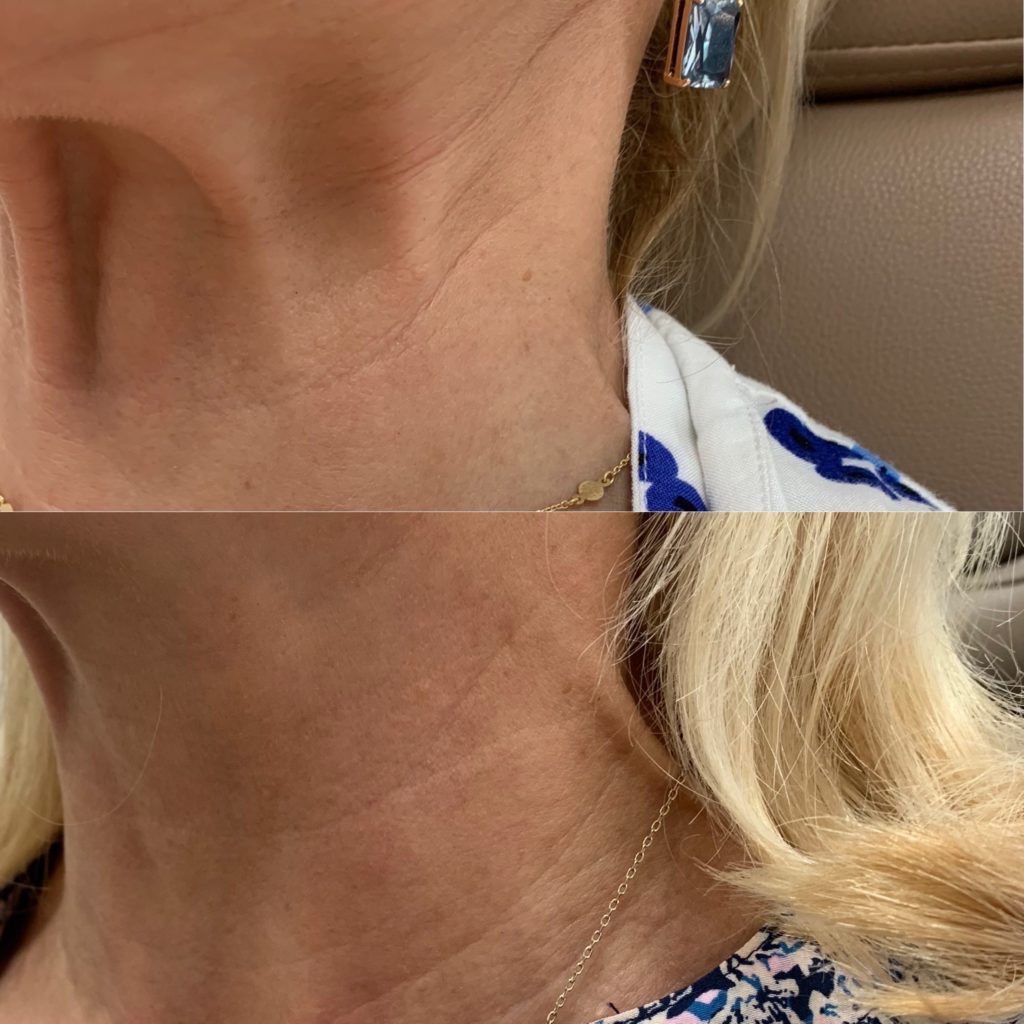 Before and After Treatment on Neck | Beauty Boost Med Spa in Newport Beach, CA