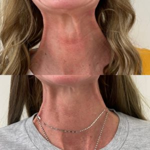 Before and After Treatment on Neck | Beauty Boost Med Spa in Newport Beach, CA