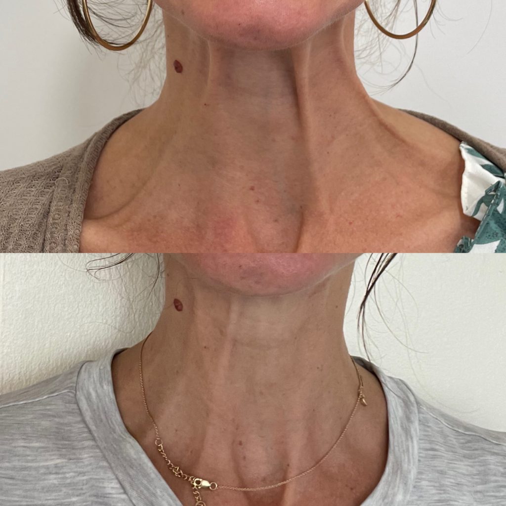 Before and After Treatment on Neck | Beauty Boost Med Spa in Newport Beach, CA