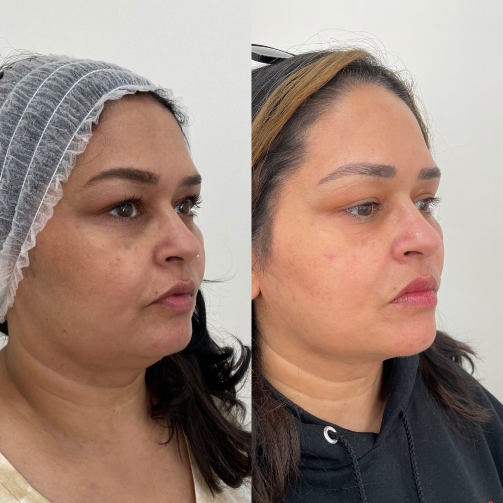 Before and After Treatment on Neck | Beauty Boost Med Spa in Newport Beach, CA
