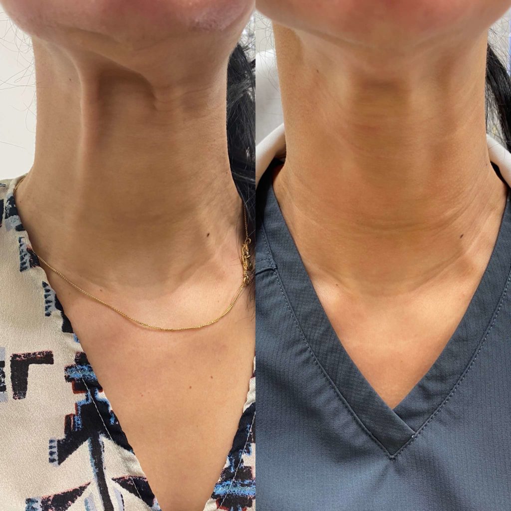 Before and After Treatment on Neck | Beauty Boost Med Spa in Newport Beach, CA