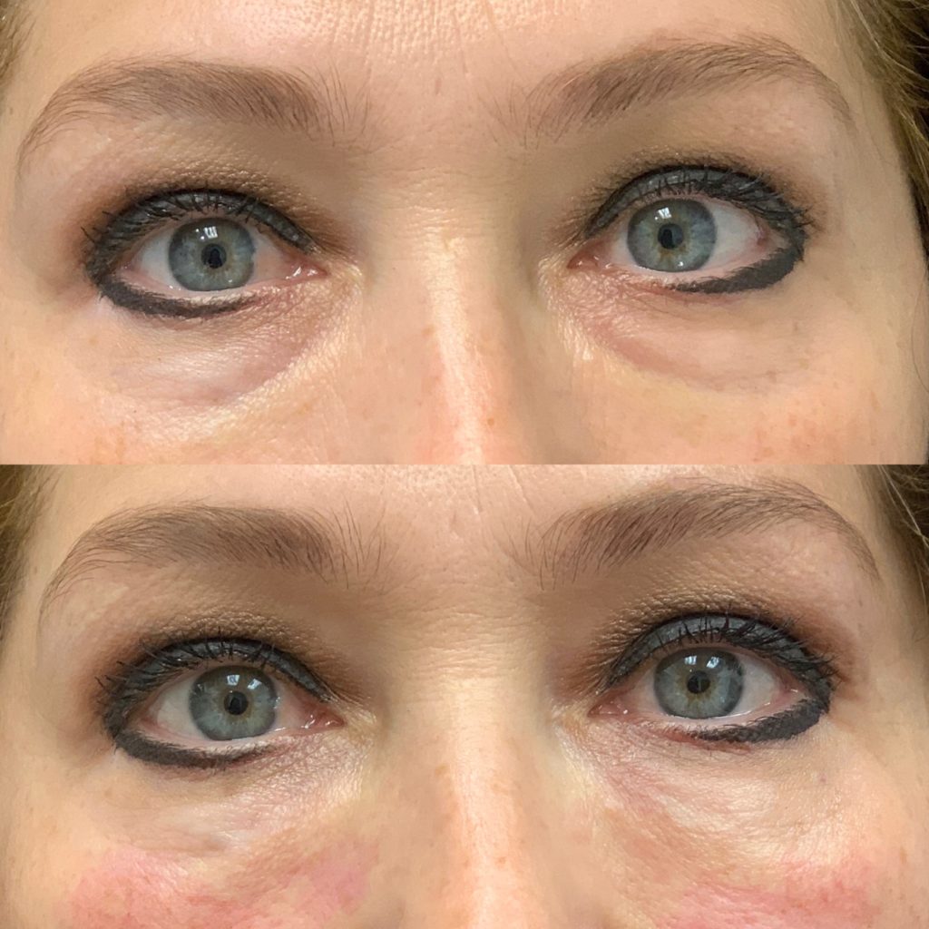 Before and After PRP/PRF Treatment | Beauty Boost Med Spa in Newport Beach, CA