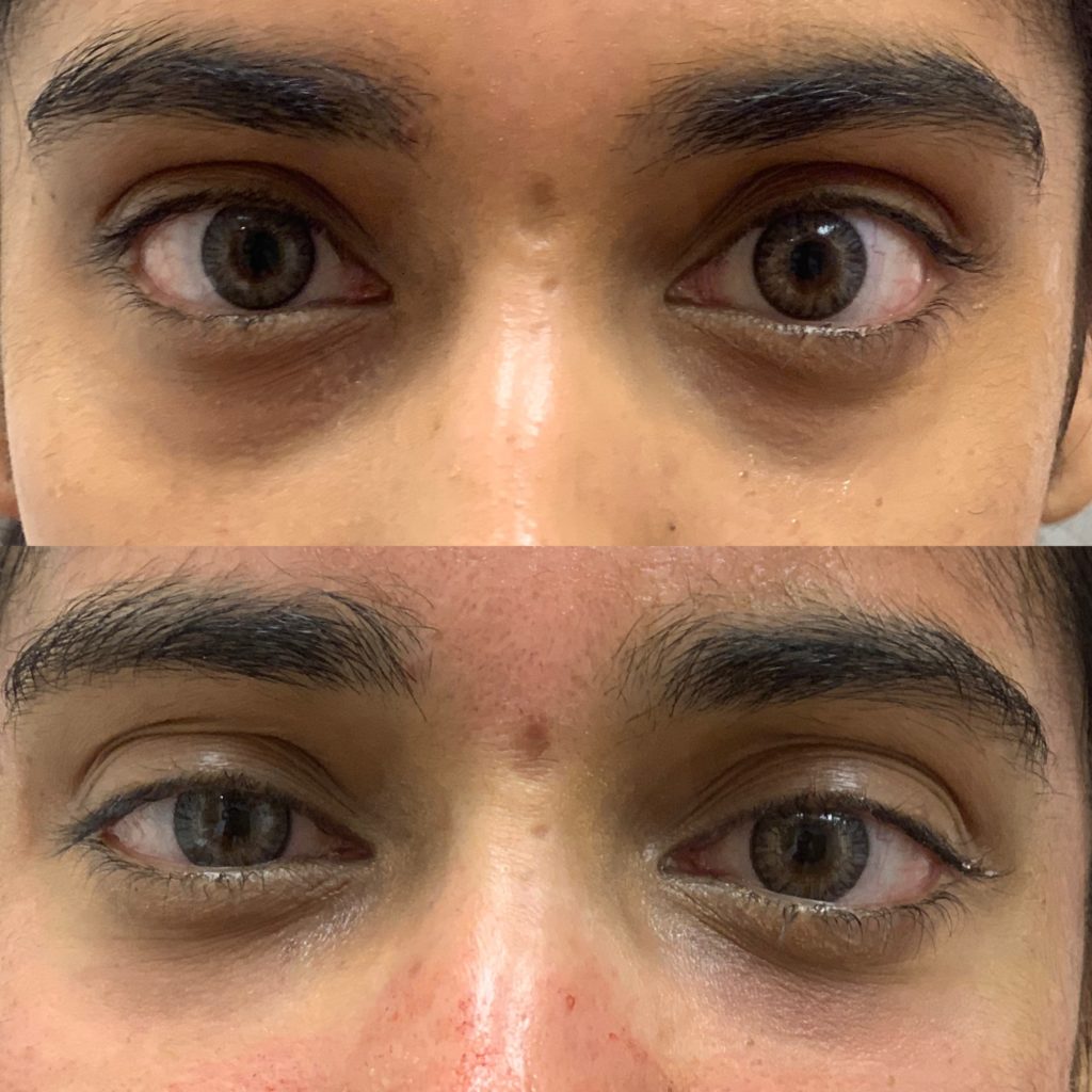 Before and After PRP/PRF Treatment | Beauty Boost Med Spa in Newport Beach, CA