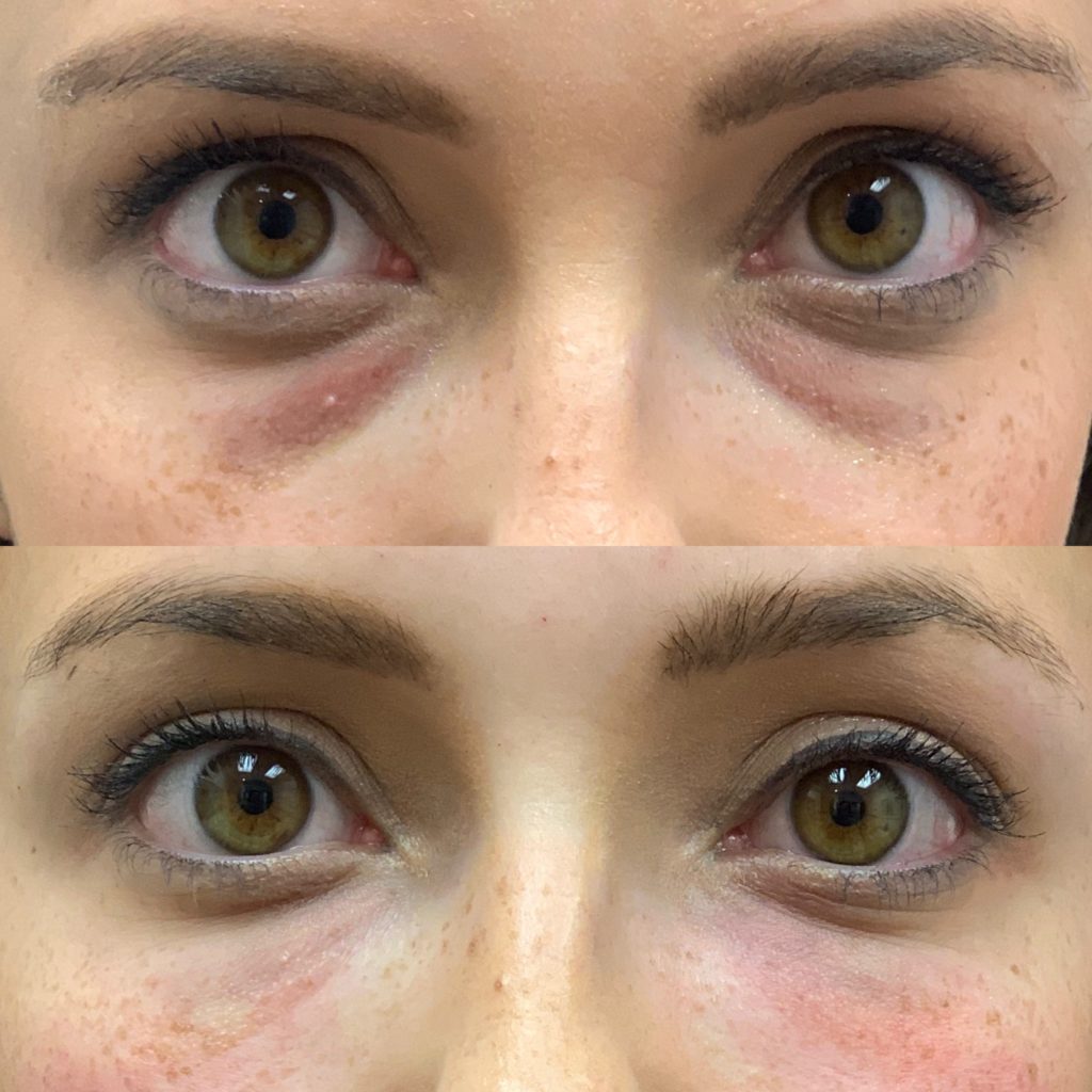 Before and After PRP/PRF Treatment | Beauty Boost Med Spa in Newport Beach, CA