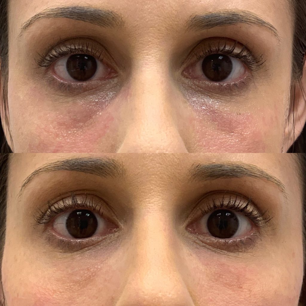 Before and After PRP/PRF Treatment | Beauty Boost Med Spa in Newport Beach, CA