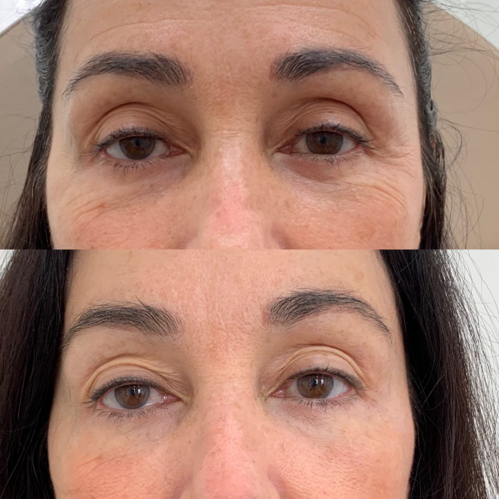 Before and After PRP/PRF Treatment | Beauty Boost Med Spa in Newport Beach, CA