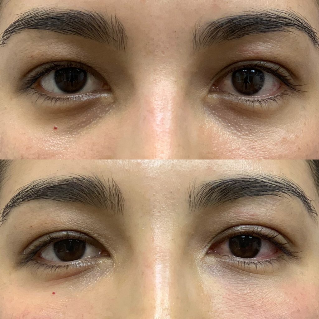 Before and After PRP/PRF Treatment | Beauty Boost Med Spa in Newport Beach, CA