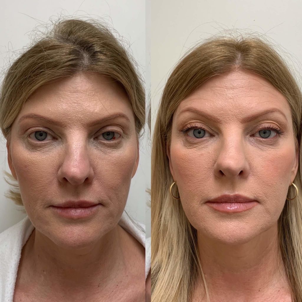 Before and After Sculptra treatment | Beauty Boost Med Spa at Newport Beach, CA