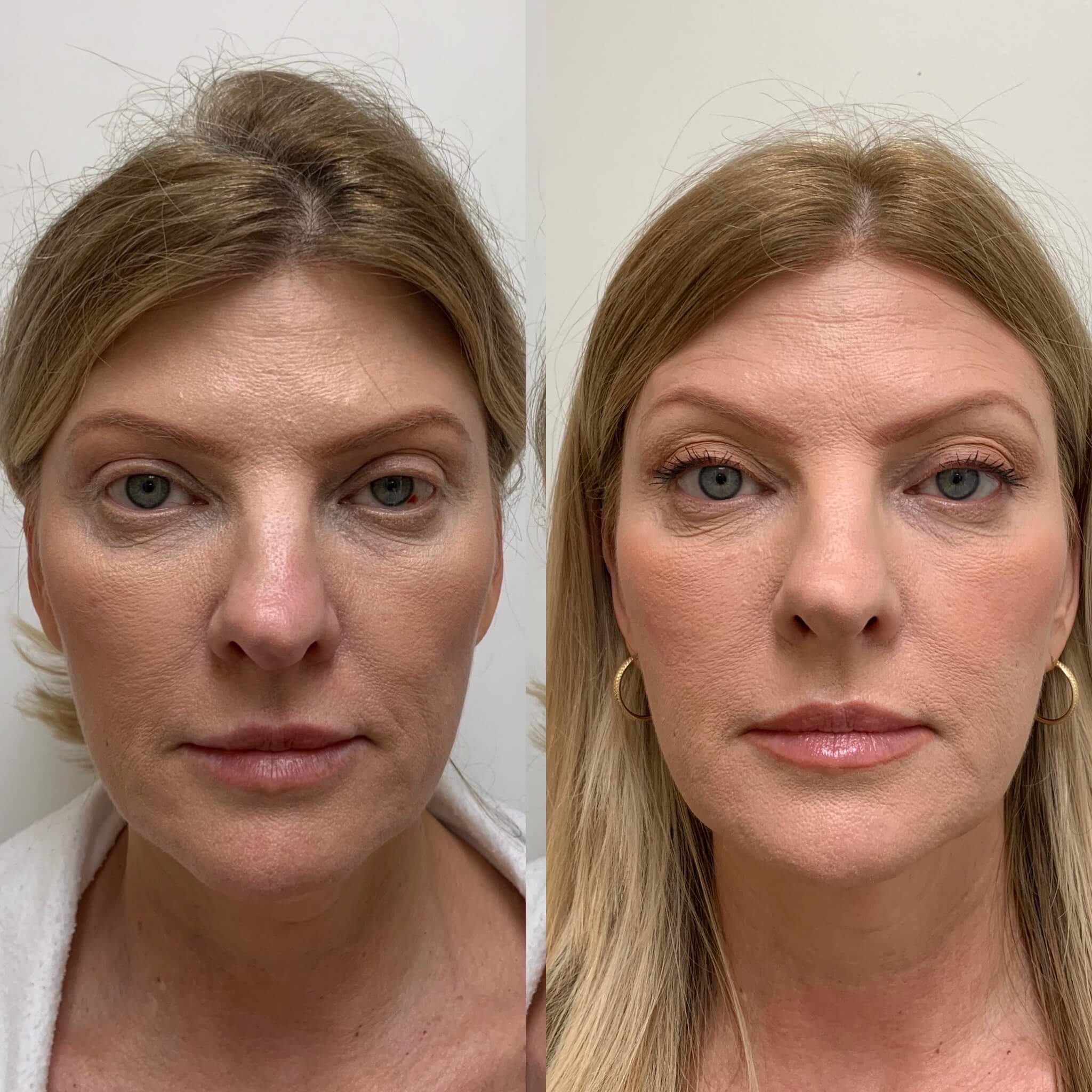 Sculptra Before After Images Medspa In Newport Beach CA