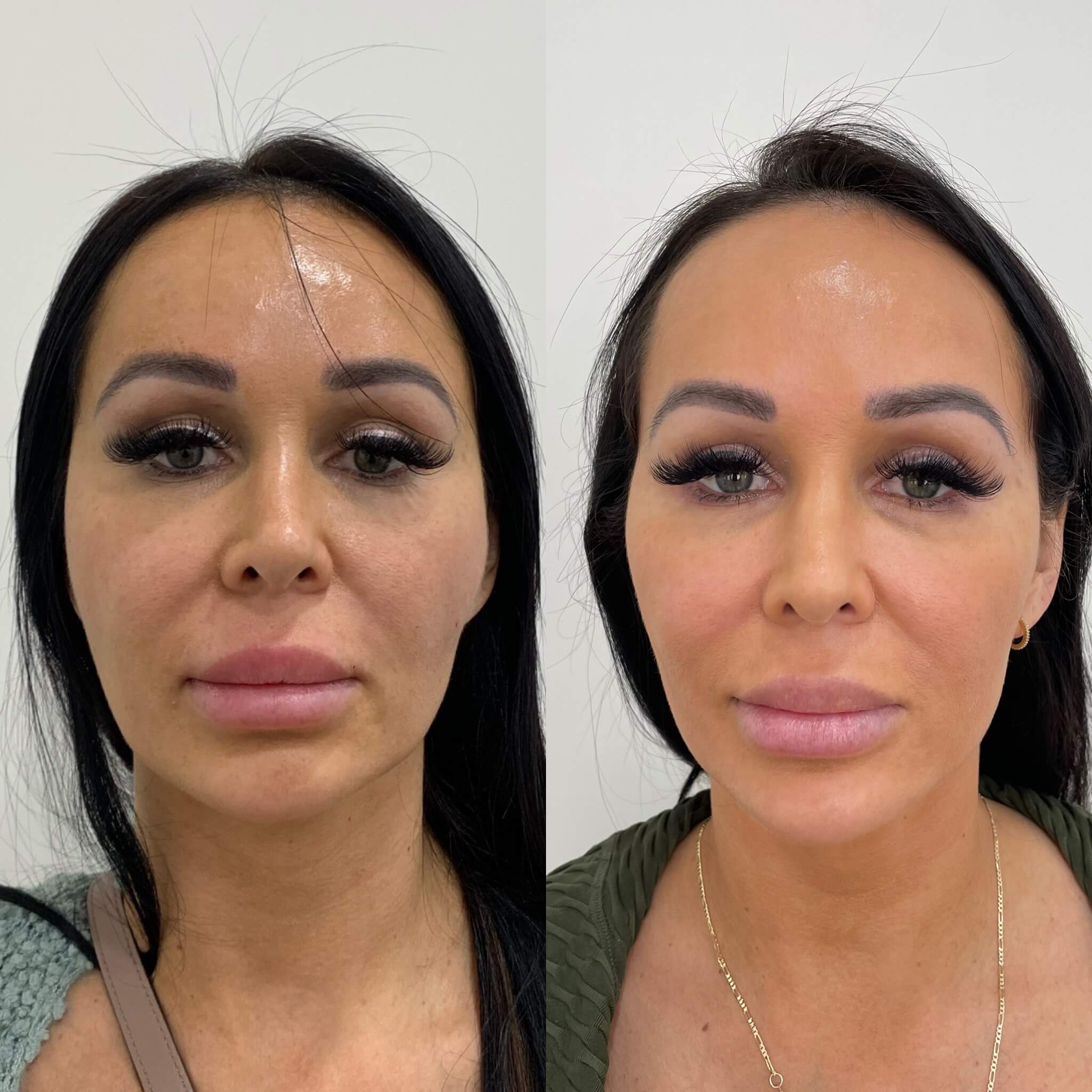 Before and After Sculptra treatment | Beauty Boost Med Spa at Newport Beach, CA