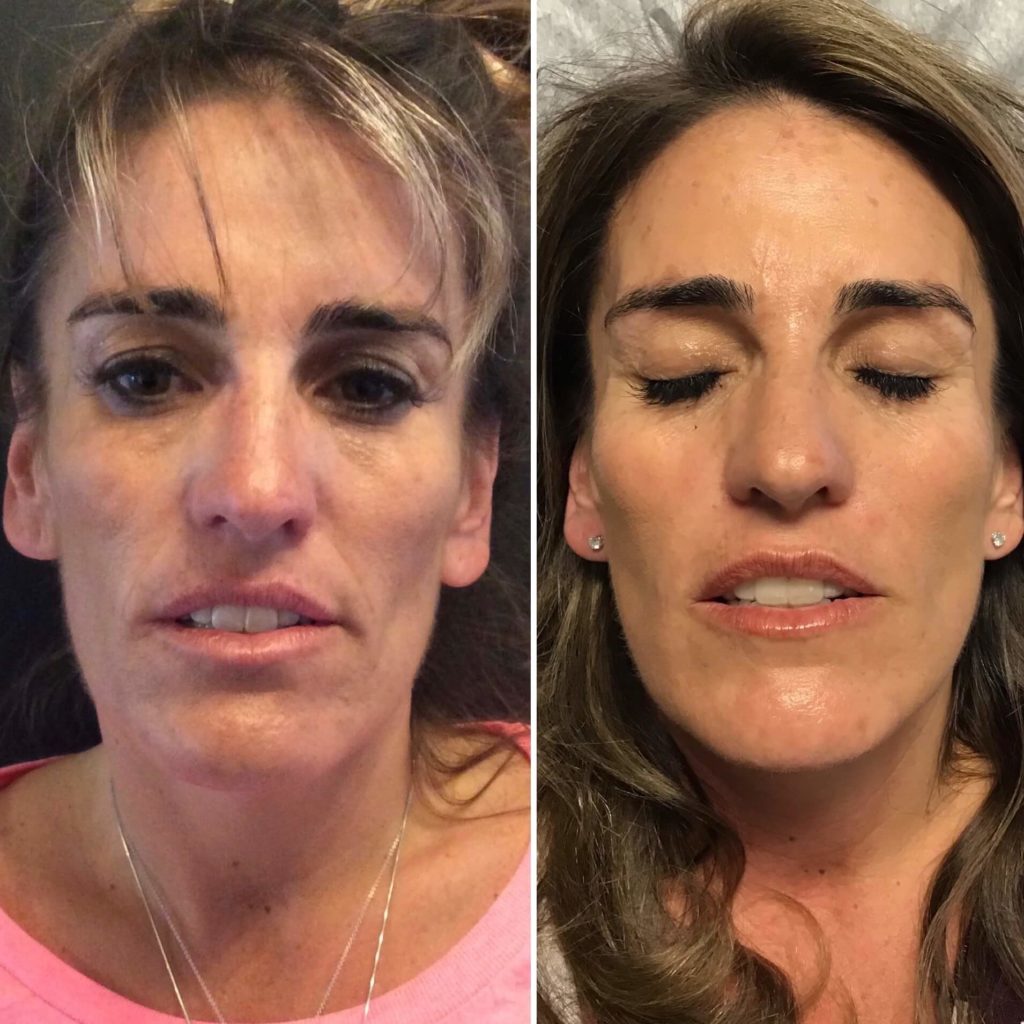 Before and After Sculptra treatment | Beauty Boost Med Spa at Newport Beach, CA