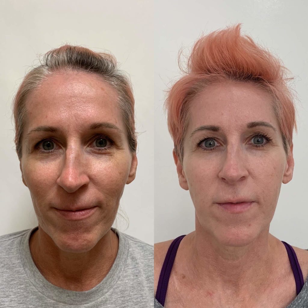 Before and After Sculptra treatment | Beauty Boost Med Spa at Newport Beach, CA
