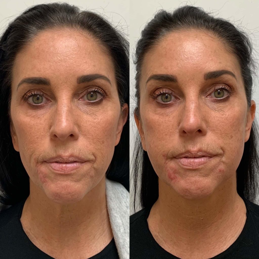 Before and After Sculptra treatment | Beauty Boost Med Spa at Newport Beach, CA