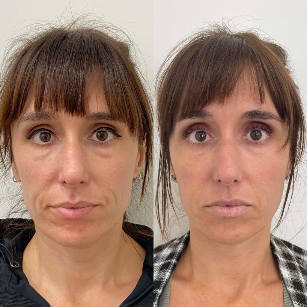 Before and After Sculptra treatment | Beauty Boost Med Spa at Newport Beach, CA