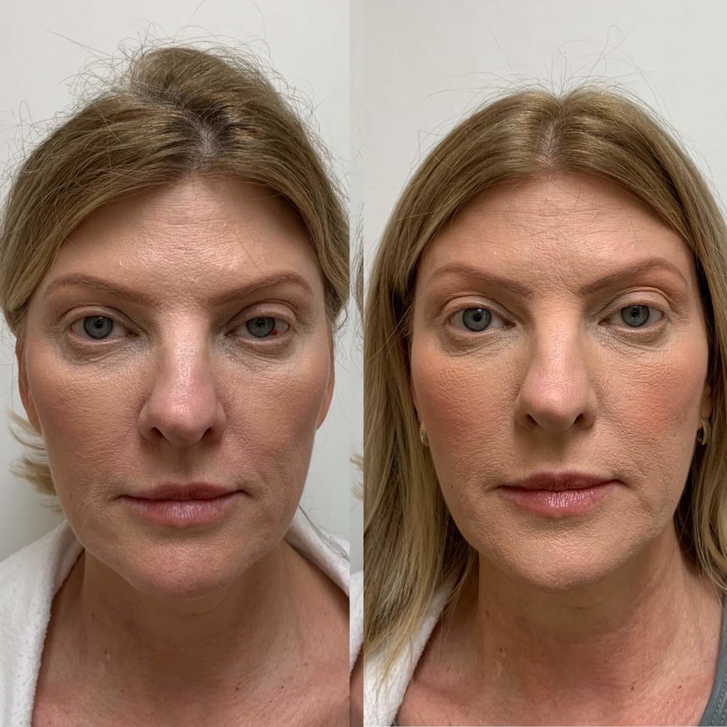 Before and After Sculptra treatment | Beauty Boost Med Spa at Newport Beach, CA