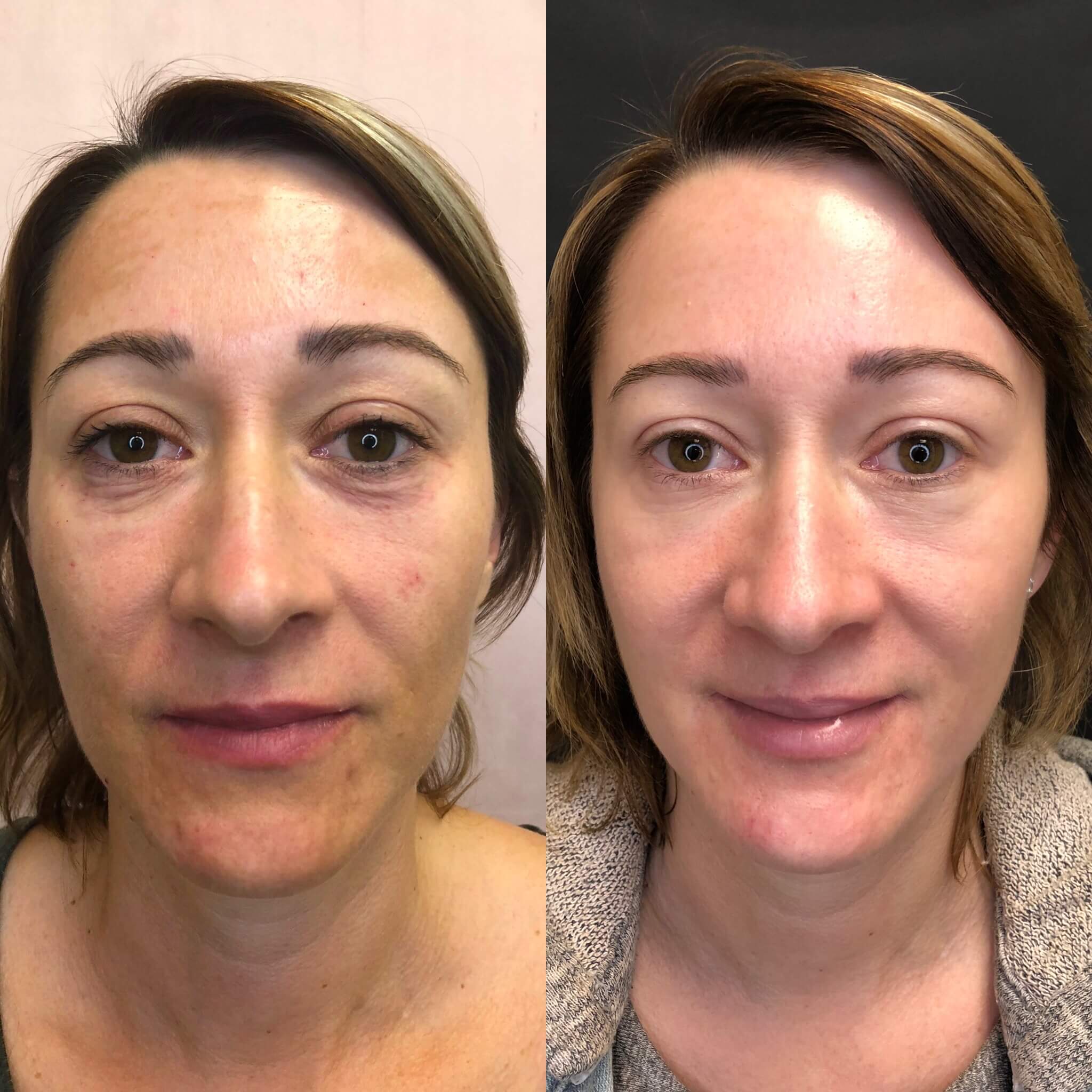 Before and After PRP/PRF treatment | Beauty Boost Med Spa in Newport Beach, CA