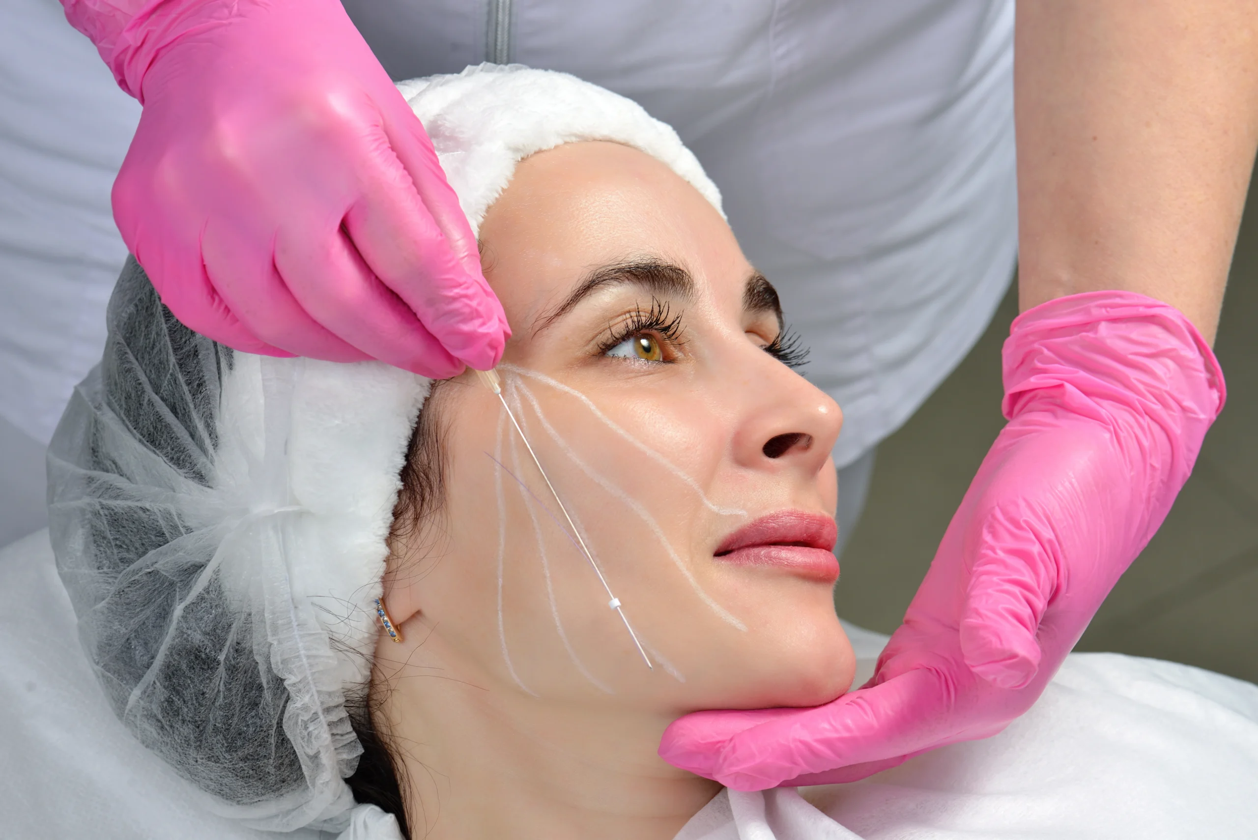 Thread Lift at Beauty Boost Med Spa in Newport Beach, CA