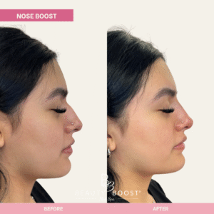 BBMS-NOSE-02-RIGHT