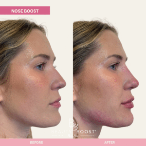 BBMS-NOSE-06-RIGHT