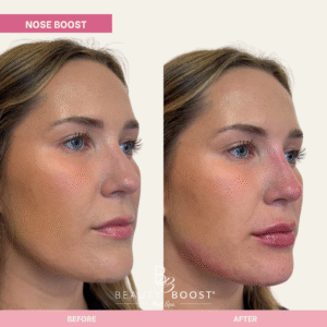BBMS-NOSE-10-R oblique