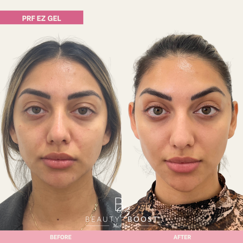 BBMS-PDGF-04-FULL FACE