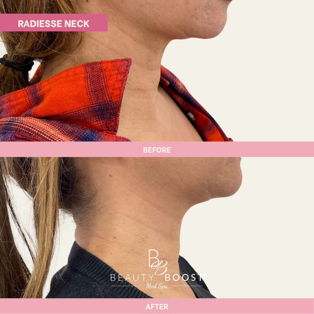 BBMS-Radiesse-03-Right