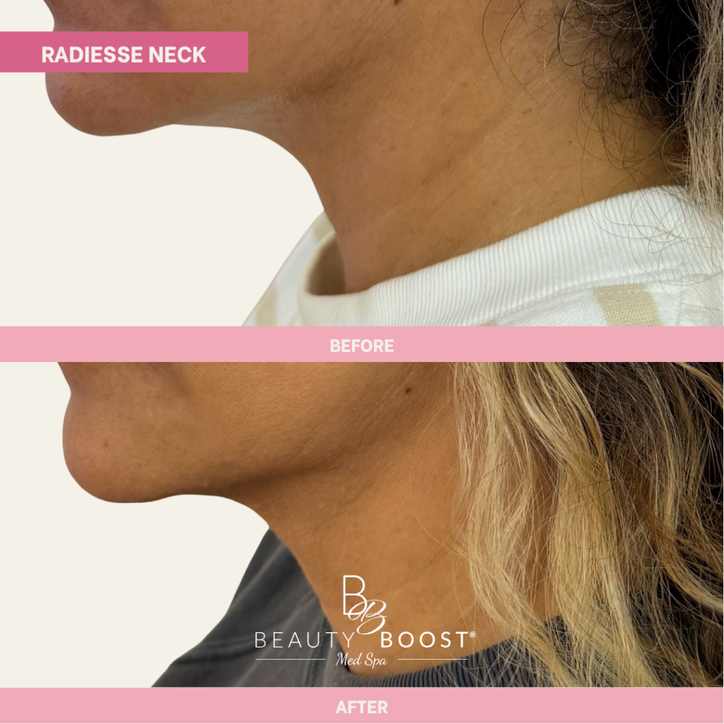BBMS-Radiesse-04-Left
