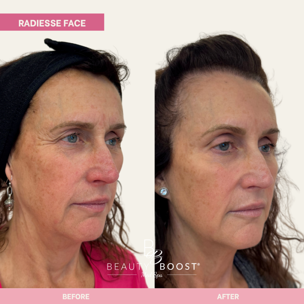 BBMS-RadiesseFace-01-right oblique