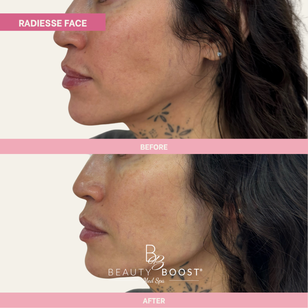 BBMS-RadiesseFace-02-Left