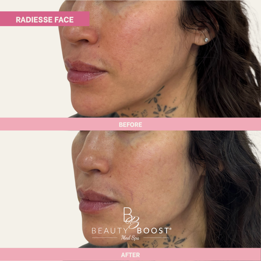 BBMS-RadiesseFace-02-Left Oblique