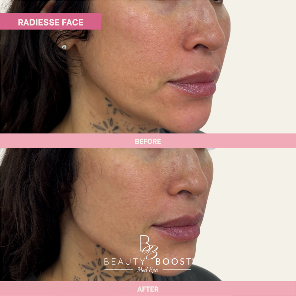 BBMS-RadiesseFace-02-Right Oblique