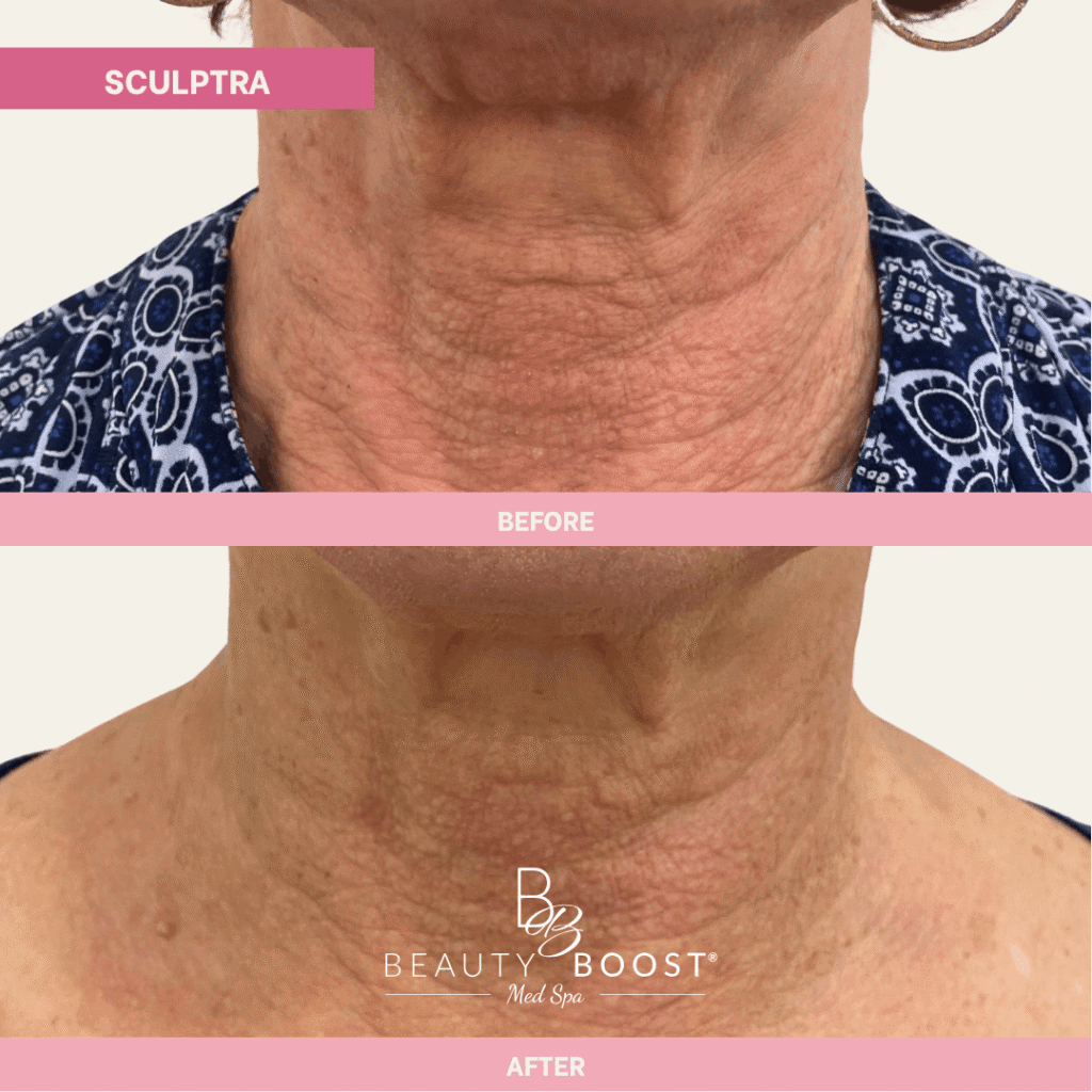 BBMS-sculptra-01-Front