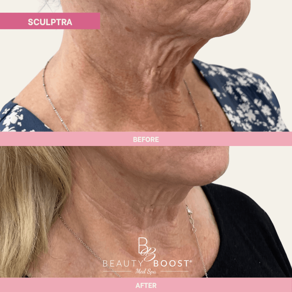BBMS-sculptra-01-Right oblique