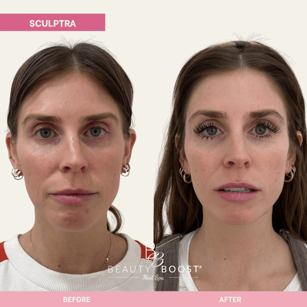 BBMS-sculptra-02 front