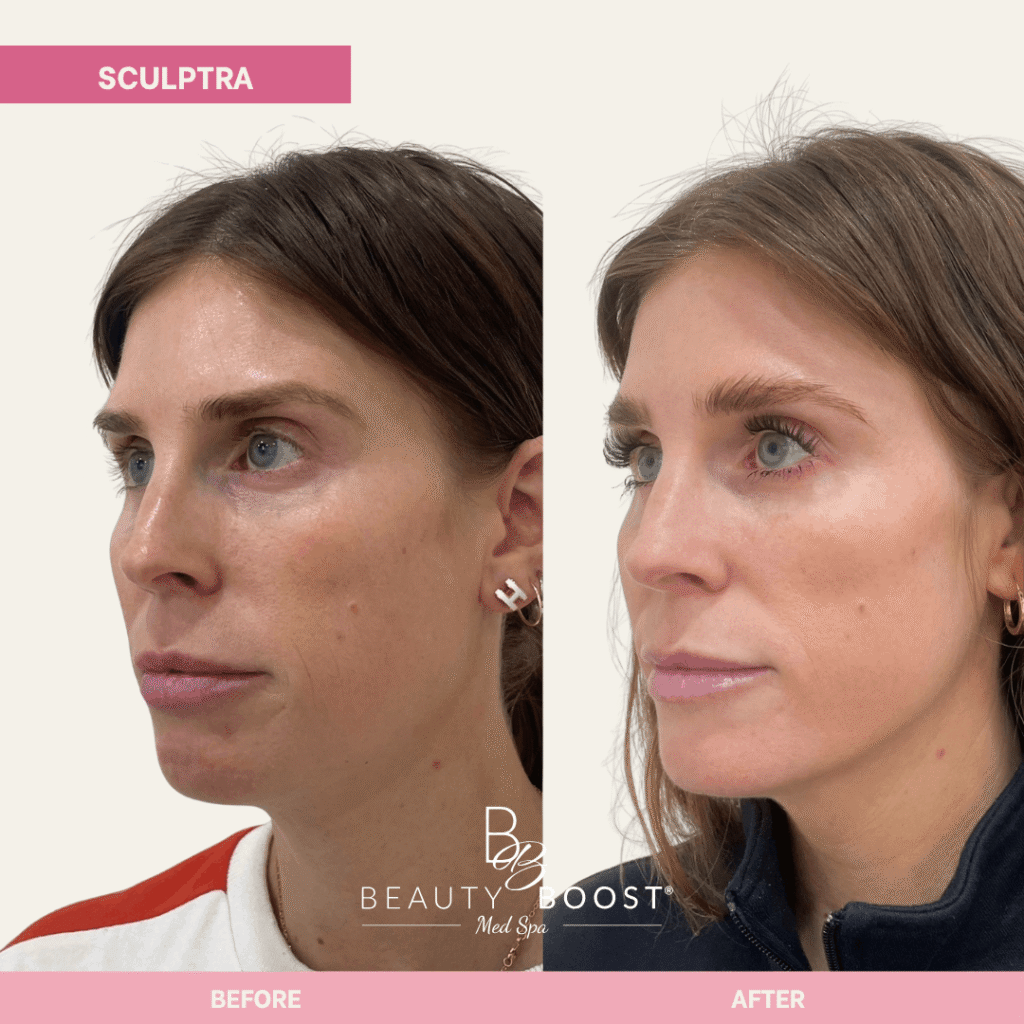 BBMS-sculptra-02 l oblique